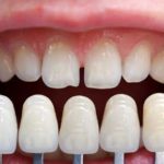 Do porcelain veneers fall off