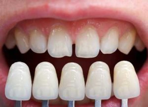 Do porcelain veneers fall off