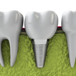 dental implants