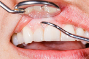 risk for periodontal disease