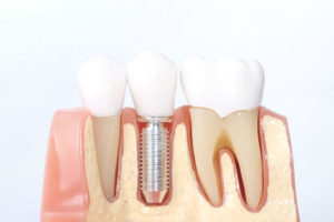 can dental implants help