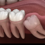 Wisdom Teeth Removal Complications