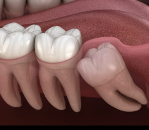 Wisdom Teeth Removal Complications