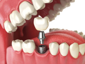 dental implants procedure recovery