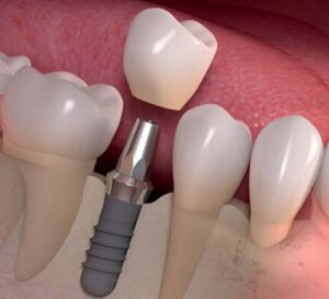 dental implants